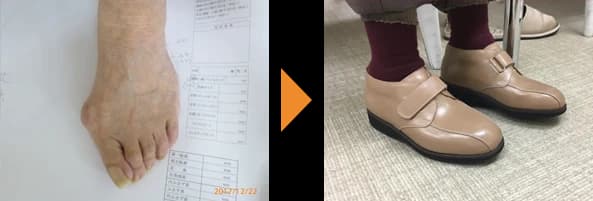 外反母趾の足（左）と、その足に合わせてつくったベージュのベルト留めの靴（右）