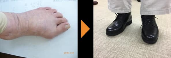 外反母趾の足（左）と、その足に合わせてつくった黒いひも靴（右）