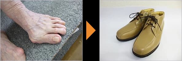外反母趾の足（左）と、その足に合わせてつくった足首まで高さのあるベージュのひも靴（右）