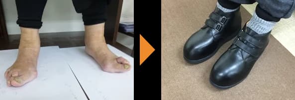指が変形した両足（左）と、その足に合わせてつくった足首まで高さのある黒いベルト留めの靴（右）