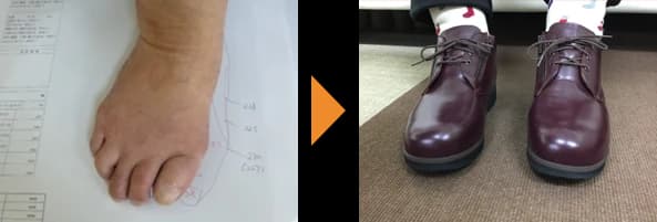 指が変形した足（左）と、その足に合わせてつくったワインカラーのひも靴（右）