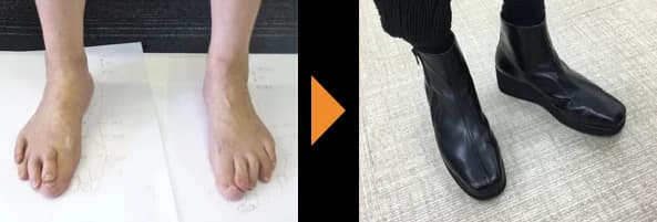 指が変形した両足（左）と、その足に合わせてつくった黒いブーツ（右）