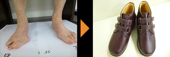 指が変形した両足（左）と、その足に合わせてつくったワインカラーのベルト留めの靴（右）