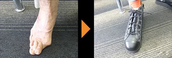 指が変形した足（左）と、その足に合わせてつくった足首まで高さのあるひも靴（右）